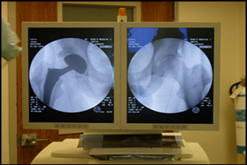 Ability to xray both hips during surgery matches surgical leg length to opposite side