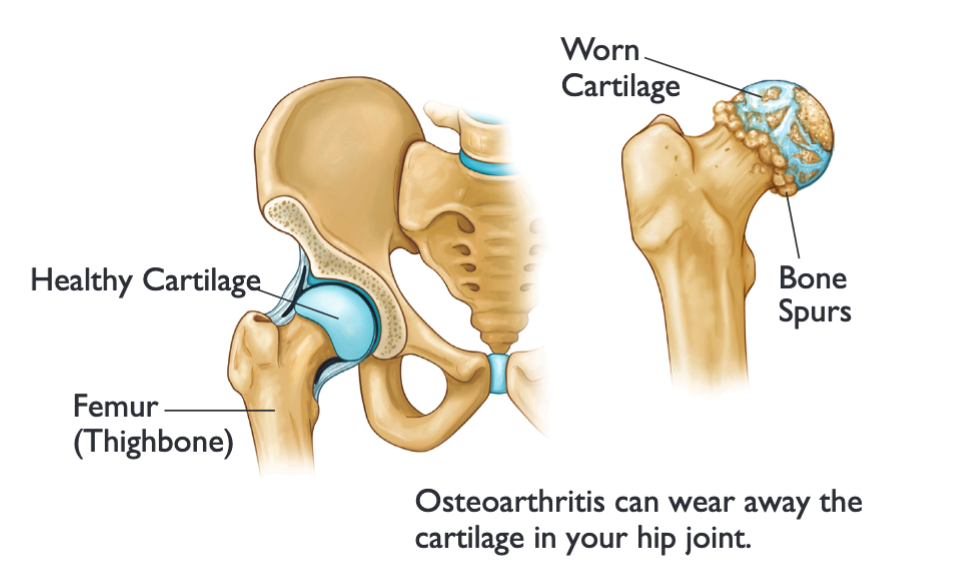 HIP ARTHRITIS