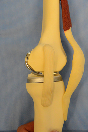 Side view of partial knee model
