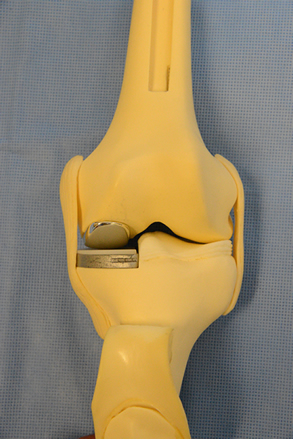 Front View of partial knee model
