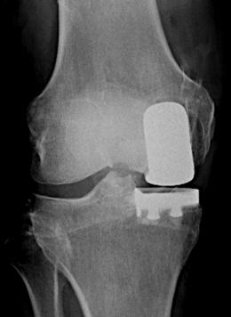 Partial Knee Xray