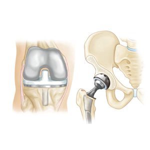 After your joint replacement surgery