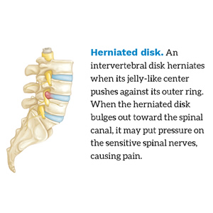 Herniated disc