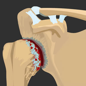 Humerus (Arm bone, head=ball)