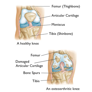 knee arthritis