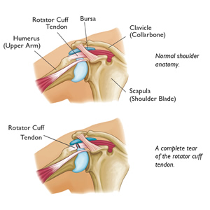 Rotator cuff tears